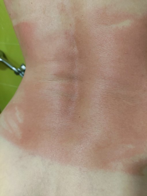 Guess where did I forgot to put the sun screen? https://t.co/542hIwLW6I, RT and FAV! https://t.co/Ib<a href="/tag/grasshopper"class="tags"><span>#grasshopper</span></a>