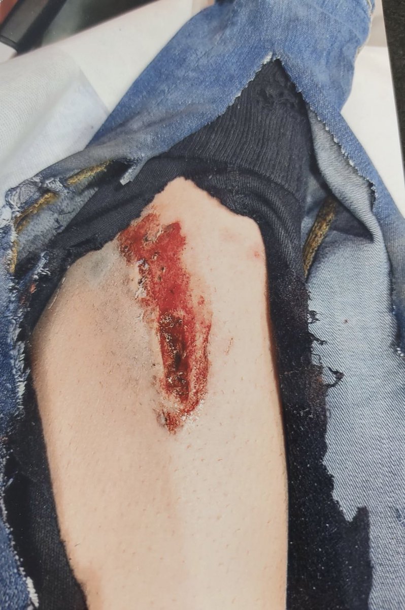 BaptistAgostini's tweet photo. 🚨9 mars vers 21h50 : manifestation à Ajaccio, une grenade de désencerclement a été tirée en l’air avant d’exploser dans les jambes de mon client. Si qq a filmé la scène ou dispose de tt élément, DM ouvert ou bac@agostinicroce-avocat.com ; dépôt de plainte + signalement IGPN https://t.co/ToLM2rYXwB