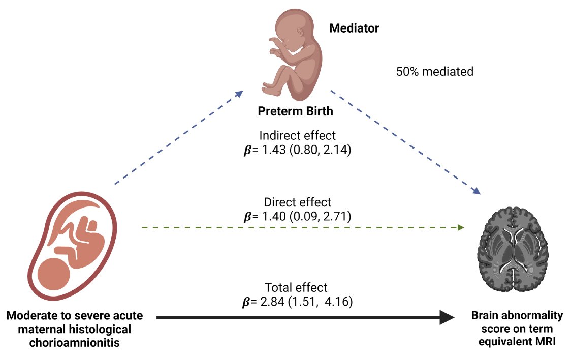 AJOG_thegray's tweet image. Acute histologic chorioamnionitis independently and directly increases the risk for brain abnormalities seen on MRI in very preterm infants ow.ly/zqNb50JjlNa