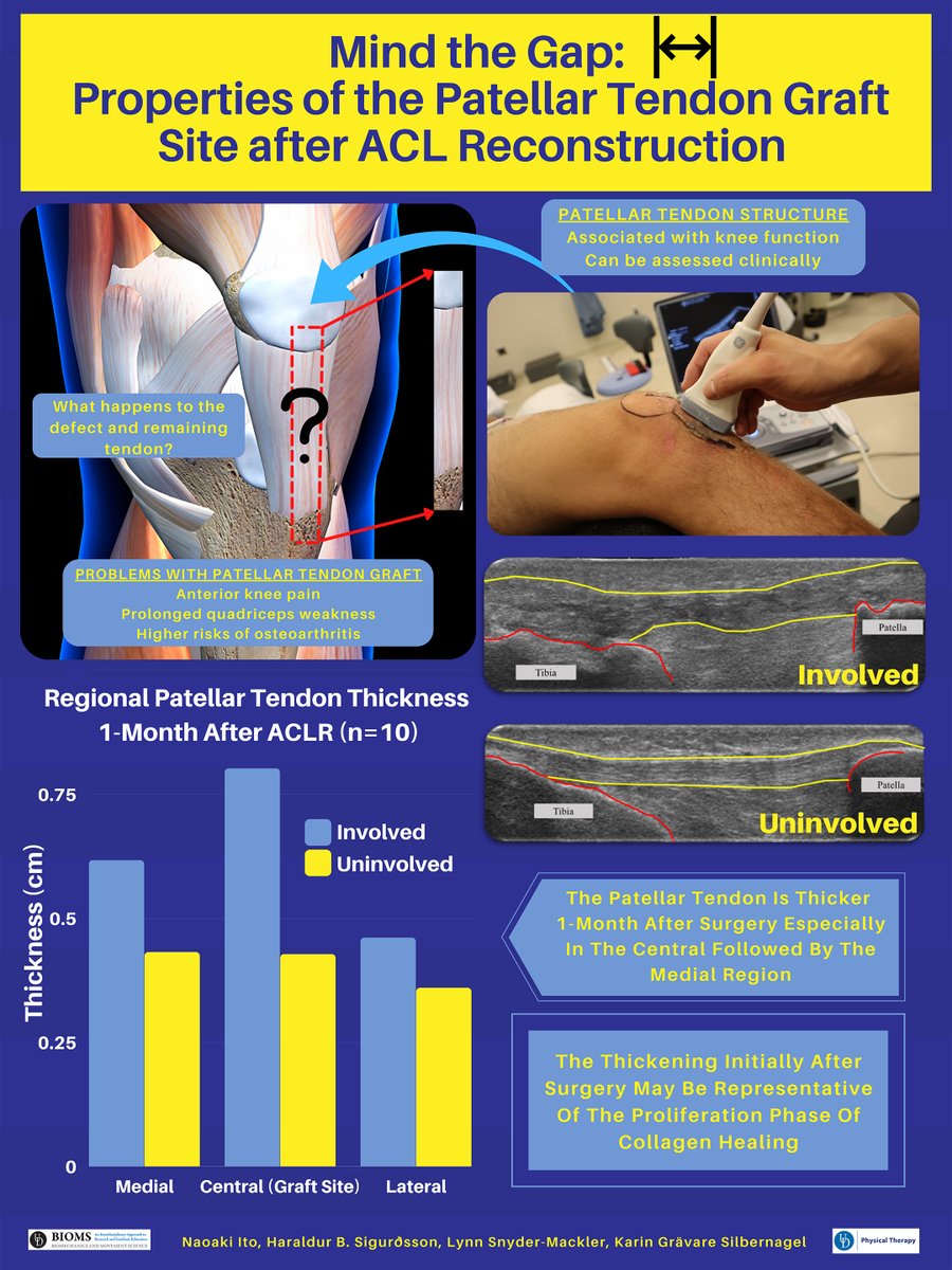 IJSPT's tweet photo. Preview "Mind the Gap: Properties of the Bone-Patellar Tendon-Bone (BPTB) Graft Harvest Site following Anterior Cruciate Ligament Reconstruction (ACLR)" by Naoski I from WCSPT, August 26-27. Register Now! https://t.co/jfUSYvbJXP https://t.co/wFGaQiNztA
