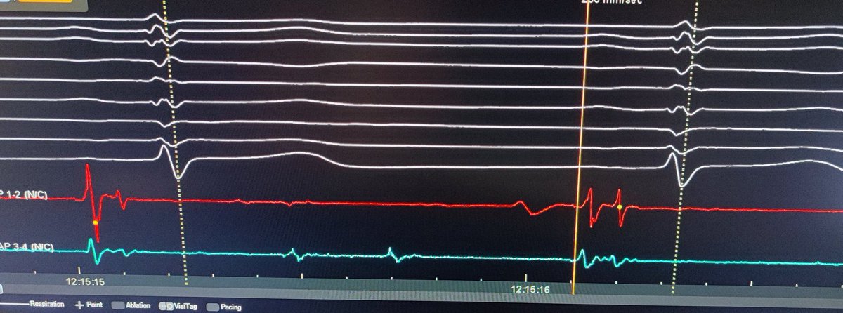 Giulio Falasconi, MD (@drfalasconi) on Twitter photo Mdct derived left atrial Wall thickness map for redo AF ablation. When it is possibile to know where previous ablation lines were deployed before performing EAM. <a href="/DrBerruezo/">DrAntonioBerruezo</a> <a href="/diegopenela1/">diego penela</a> <a href="/Davidsotoiglesi/">David soto-iglesias</a> <a href="/julio93383971/">Julio Martí Almor</a> <a href="/Dr_SanAntonio/">Rodolfo San Antonio</a> <a href="/JAldereteM/">José Alderete M</a> <a href="/daniviverosf/">Daniel Viveros</a> <a href="/ADAS3D/">ADAS3D Medical</a> Mdct derived left atrial Wall thickness map for redo AF ablation. When it is possibile to know where previous ablation lines were deployed before performing EAM. <a href="/DrBerruezo/">DrAntonioBerruezo</a> <a href="/diegopenela1/">diego penela</a> <a href="/Davidsotoiglesi/">David soto-iglesias</a> <a href="/julio93383971/">Julio Martí Almor</a> <a href="/Dr_SanAntonio/">Rodolfo San Antonio</a> <a href="/JAldereteM/">José Alderete M</a> <a href="/daniviverosf/">Daniel Viveros</a> <a href="/ADAS3D/">ADAS3D Medical</a>