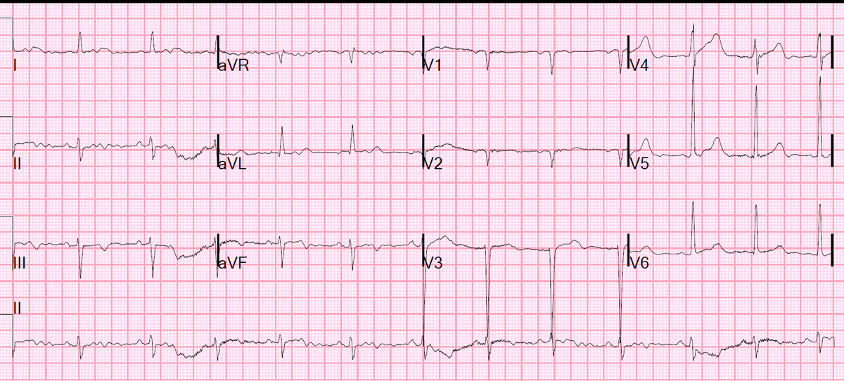 smithECGBlog's tweet image. Does a single troponin below the 99th percentile URL rule out Acute MI if constant chest pain has been very prolonged at the time of ED presentation?

hqmeded-ecg.blogspot.com/2022/05/does-s…

ECG 1: Day 1, patient sent home
ECG 2: Day 2, patient presents in cardiogenic shock

What happened??