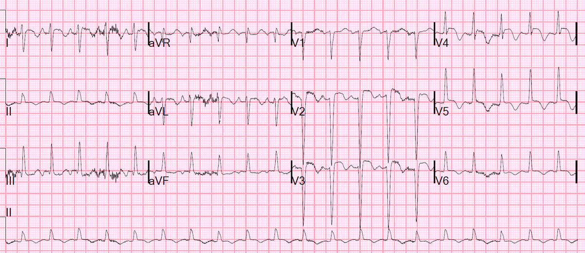 smithECGBlog's tweet image. Does a single troponin below the 99th percentile URL rule out Acute MI if constant chest pain has been very prolonged at the time of ED presentation?

hqmeded-ecg.blogspot.com/2022/05/does-s…

ECG 1: Day 1, patient sent home
ECG 2: Day 2, patient presents in cardiogenic shock

What happened??