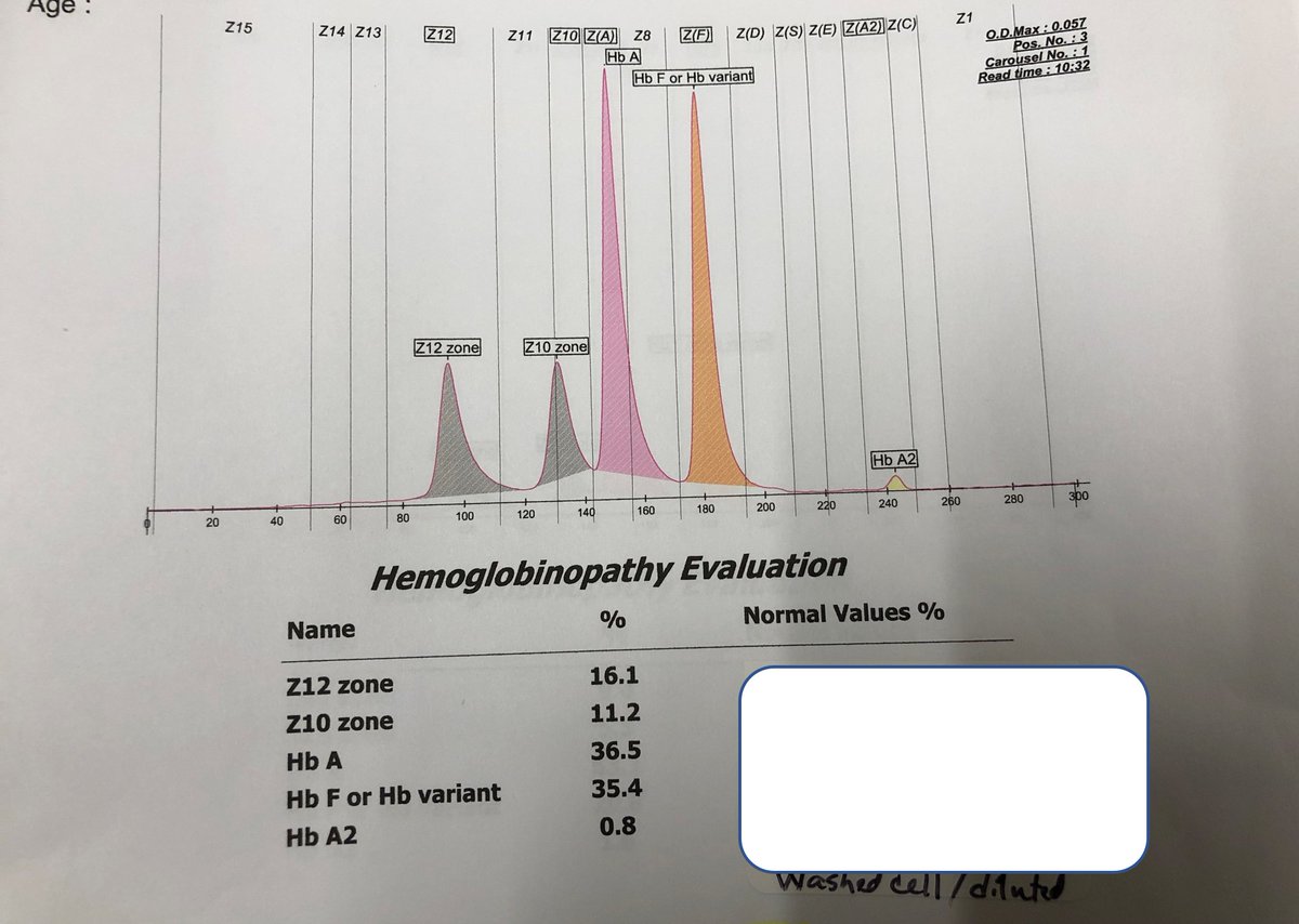 jayati_mallick's tweet photo. A beautiful one, 2 month old baby....do you have any Idea? I am pretty sure that it is Hemoglobin Wayne, a spectacular hemoglobin variant: one mutation=Two peak. All credits goes to our resident Alyeesha Wilhelm for her detail research on it. https://t.co/yYQYr0ZYtt