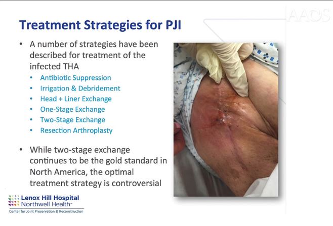 One-stage exchange after #THA to manage PJI is growing in popularity. Thomas Fleeter, MD reviews an #OVT video by H. John Cooper, MD, and colleagues describing the 7-step process in 2 phases: bit.ly/3sTrXOj #AAOSNow #OVTFridays @HepinstallMD @JArthroplasty @MIStotaljoint