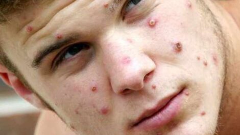 Monkey Pox has not yet been confirmed in any African country. But western medias have been reporting about Monkey Pox using Black/African people images.