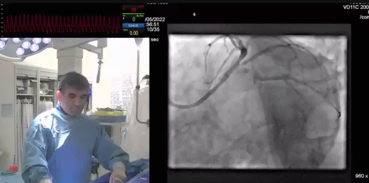 SulemanAktaa's tweet image. Great live #PCI case today by @MohanedEgred T-stenting LM bifurcation using #IVUS &amp;amp; #rotablation 
#CHIP @ammozid 
 Learning messages:
🤔planning is key 
🔎use all available info from previous procedures
 🎯Keep it simple