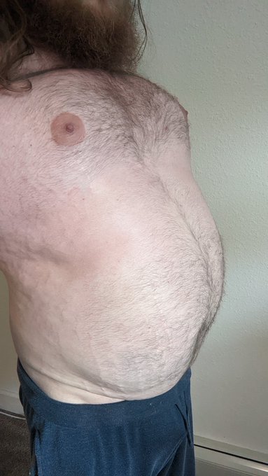 I tried something new. No video, but here's some photos. I inflated my chest with N2O. I started with