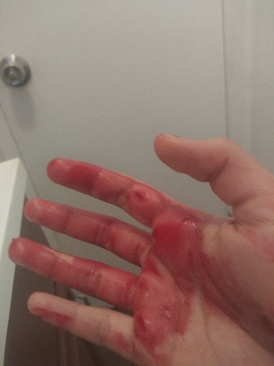 duncantrussell's tweet photo. Another successful home surgery!  My patient has one less appendix and one less brutal medical bill.   My bloody hand represents the home surgery revolution.  #bloodyhands https://t.co/598jH7cVlU