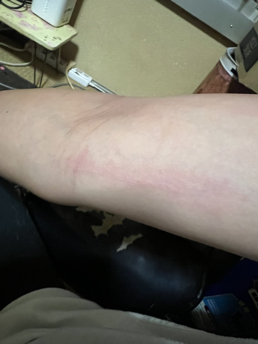 ARASHIANS_ayu's tweet image. おねぇね〜って甘えてくる、どちゃくそ可愛いハクトと、ゾンビごっこして遊んだら勲章が出来たwww

腕に引っかき傷と黒のスキニーに換毛期の毛がどっさりとwww

昨日から始めたゾンビごっこが楽しいみたいで、遊ぼうよ！って誘ってくるw

 #柴犬ハクト 
 #ゾンビごっこ 
 #柴犬のいる暮らし 
 #楽しい