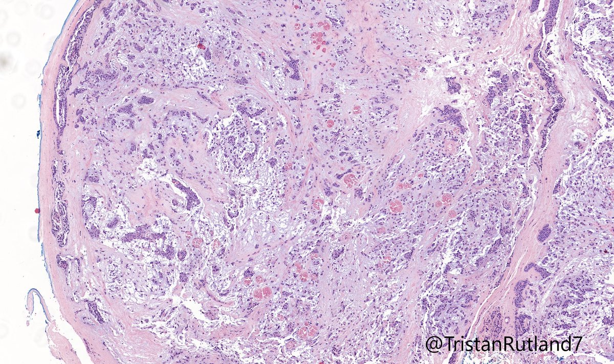 ✏️External auditory canal nodule.

❓What type of tumour is this?

➡️For more questions, follow the t...
