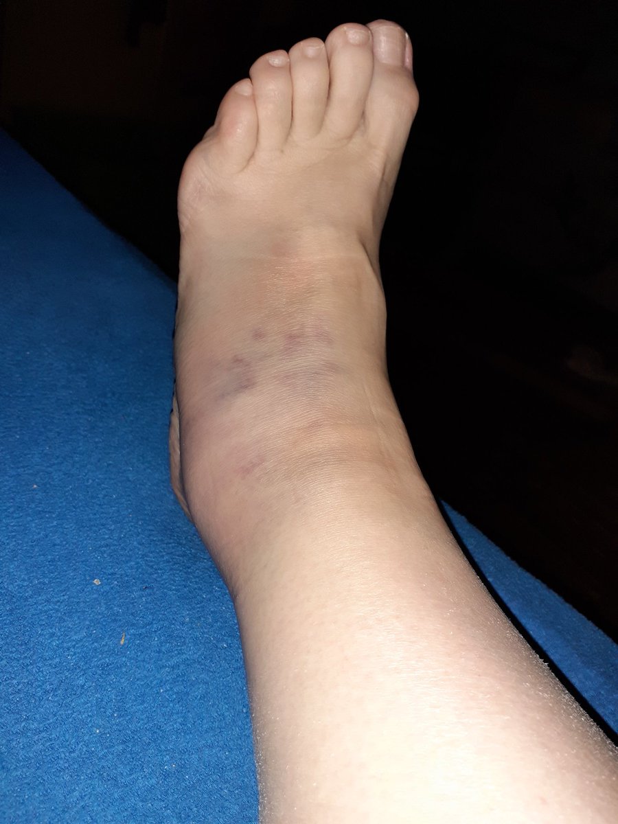 AtlanticLover65's tweet photo. #Peakerdown 😬 yes. Maybe I am too stupid to walk into my own living room #MyPeakChallenge I'll take a short break... but it looks worse than it actually is 🙈 https://t.co/gOBH2E9l6L