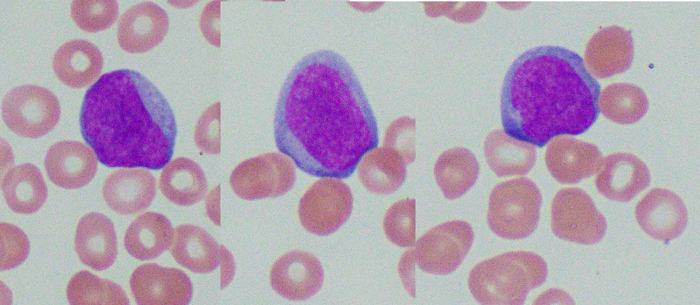 bethmcm's tweet photo. Circulating neuroblastoma in peripheral blood, flagged as "blasts" by Sysmex.  Concurrent bone marrow exam showed extensive involvement by disease. #PathTwitter  #hemepath https://t.co/CPFaeqDIwC