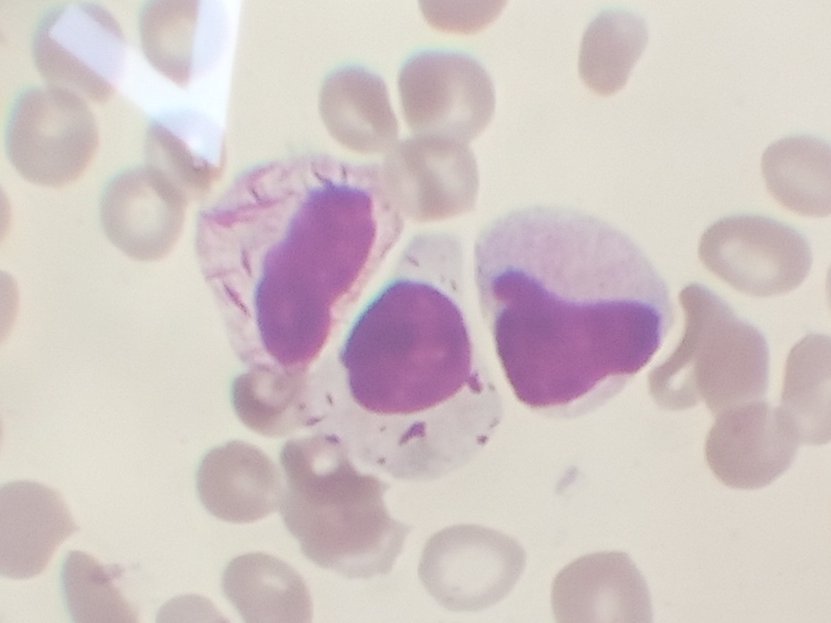 31yr F, 1month Hx of recurrent fever, repeated transfusions, gum bleeds, Bleeding PV,petechiae Hb - 6, PCV 18, WBC - 42, PLT 45. Prolonged PT and APTT. 
PBF shown below.
#PathTwitter