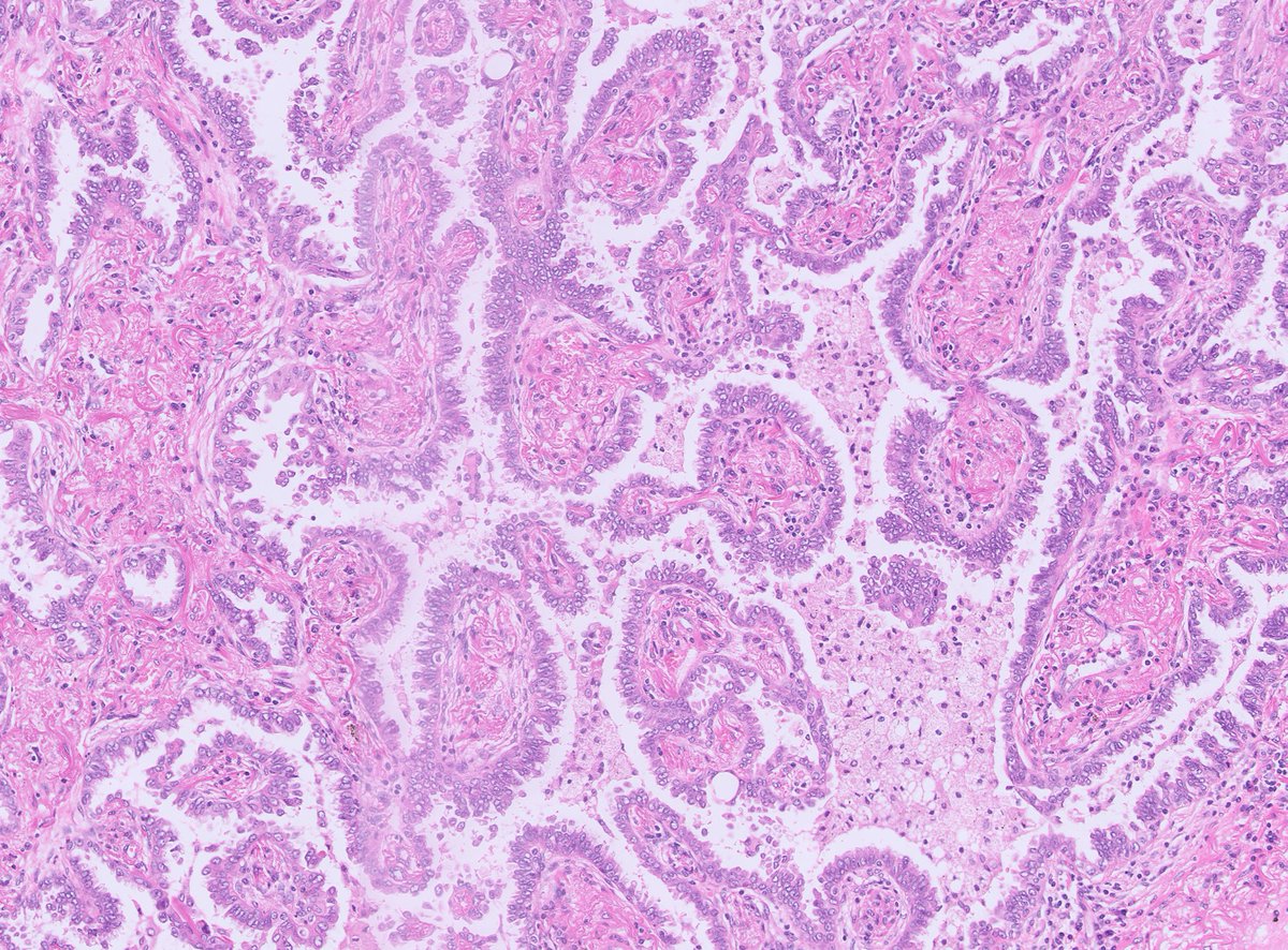 Interested in a thoracic pathology consultant post in <a href="/NHS_Lothian/">NHS Lothian</a>?  Currently advertising (apply.jobs.scot.nhs.uk/displayjob.asp…). Deadline 8th July 2022. Great team and variety of research / teaching opportunities. Feel free to get in touch #lungpath #pulmpath #pathology #pathjobs