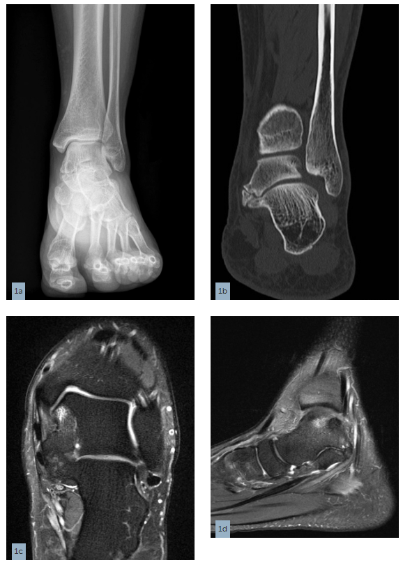 RadsourceLLC's tweet photo. In our June MRI Web Clinic, Drs. Cheng, Smitaman, and Resnick provide an in-depth review of the anatomy and pathologies associated with a characteristic cause of foot and ankle pain. #radiology #mri #medicalimaging

https://t.co/6UKIbKXPFQ https://t.co/k4PVW5tZyh