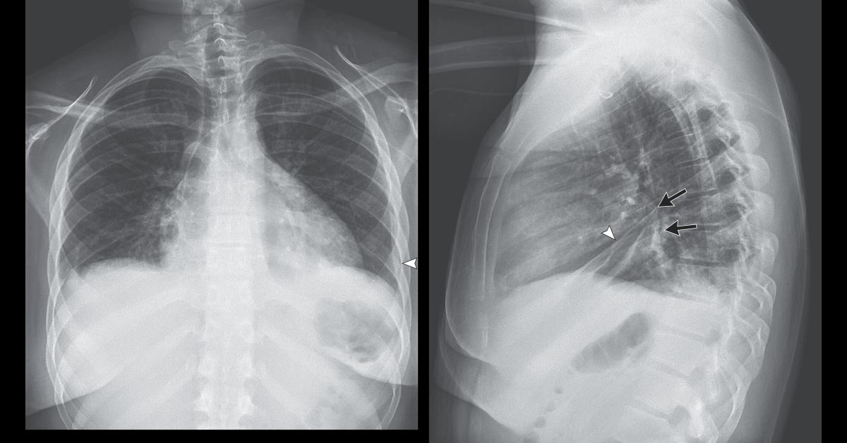 NEJM (@nejm) on Twitter photo A 17-year-old boy was admitted to the pediatric ICU with chest pain, syncope, ECG abnormalities, and elevated creatine kinase and troponin T. He had been well until 5 days earlier. nej.md/39hgWzD A 17-year-old boy was admitted to the pediatric ICU with chest pain, syncope, ECG abnormalities, and elevated creatine kinase and troponin T. He had been well until 5 days earlier. nej.md/39hgWzD