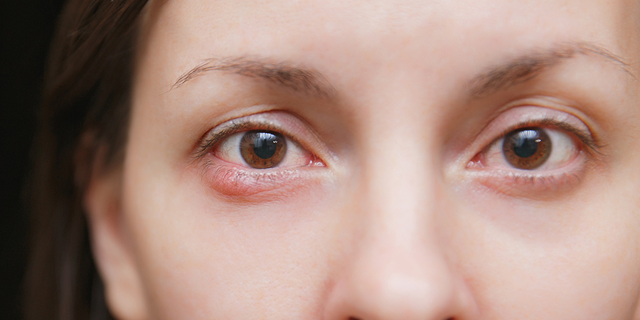AOAConnect's tweet image. Children who don't get enough vitamin A may be at an increased risk of developing chalazion, according to a recent study. Learn more: ow.ly/6kEn50JtBnc.