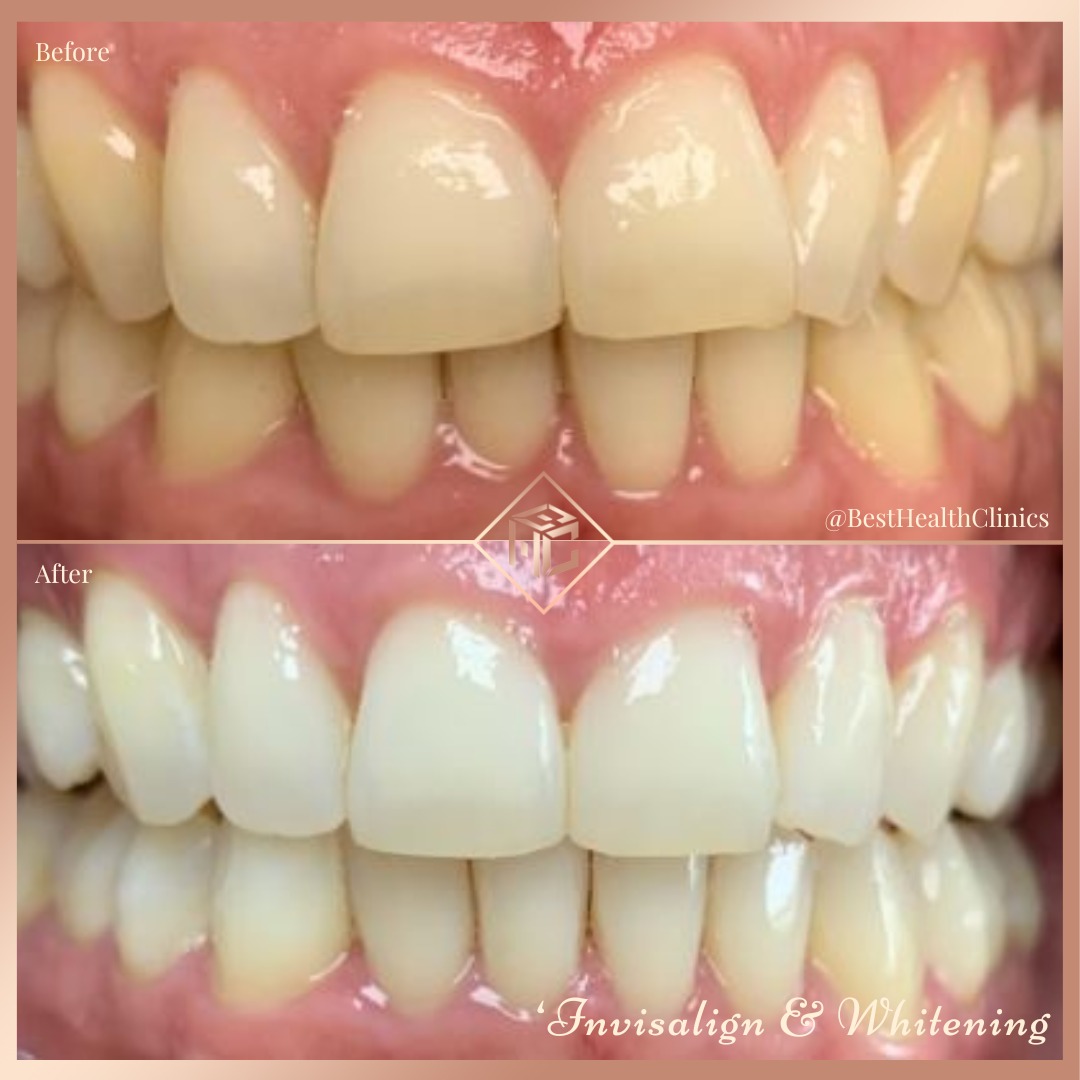 ✨INVISALIGN &amp; TEETH WHITENING✨
Our lovely patients who started their Invisalign journey with us and also done our pola night whitening!🦷🤍
To get booked in for your complimentary
consultation-
📞call us - 01708 477 577
📧 email us - info@bhclincs.com
📥 dm us to get booked in!