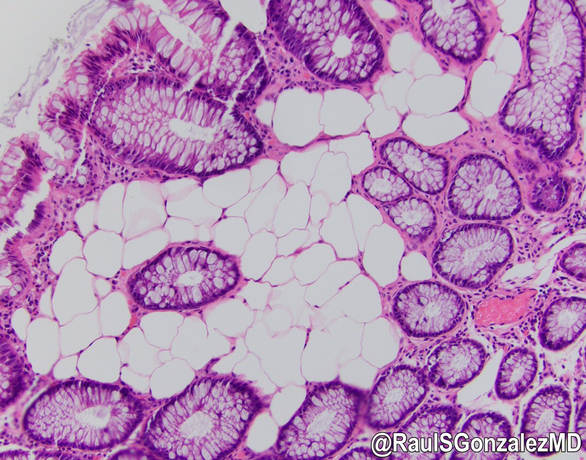 Look at this cute little intramucosal lipoma of the colon. A subset of patients with these will have Cowden syndrome, so it's probably worth mentioning that somewhere in your signout report. bit.ly/3trUpqH #pathology #gipath #PathTwitter #PathOutPic