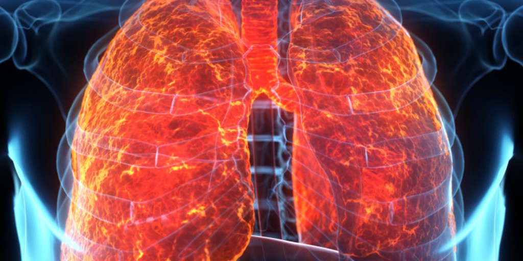 AASMorg's tweet photo. Poor #sleep is associated with a significantly increased risk of life-threatening flare-ups in people with chronic obstructive pulmonary disease (#COPD), according to a new study supported by @NIH. https://t.co/oCcdHQD9Tc https://t.co/2w1K3iI3a1