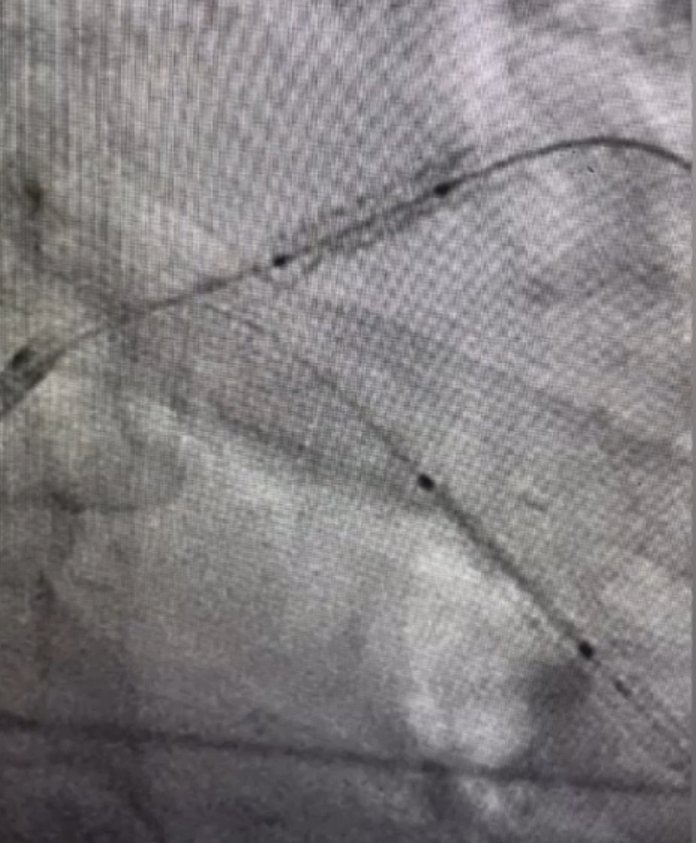 Yurtdışında stenti ana damara kaçırılan hasta bnm yakınım bu operasyonu İstanbul'da başarı ile gerçekleştiren Prof.dr.Nihat Özer 
Demekki neymiş Türk hekimlerinin değerini bilmek gerekirmiş.