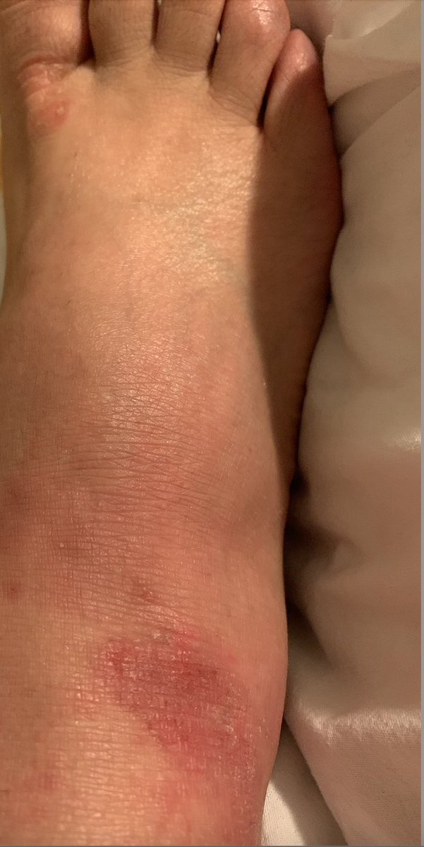 When a simple mosquito bite can start a full-on reaction and may lead to a Psoriasis spot. 

Mind over body. Accept what you can control and what you can't. 

Listen to your body, and most importantly... DO NOT SCRATCH!