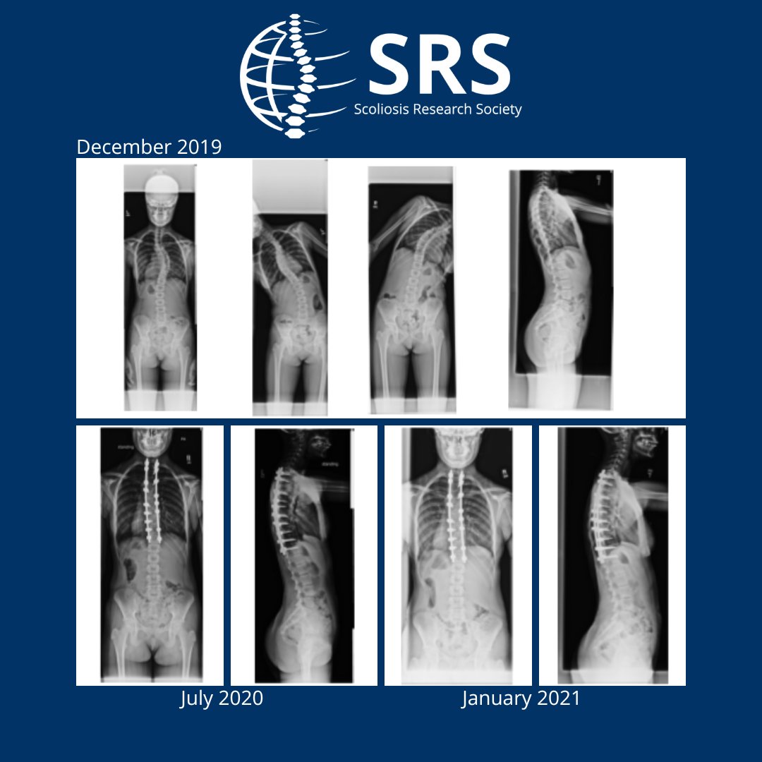 SRS_org's tweet photo. This is a 13-year-old female with 49 degree thoracic curve. She had posterior spinal fusion in 2019 and was participating in sports after six months from surgery. #SRSCaseDiscussion #SRSSAM https://t.co/nTsl4qoK8B