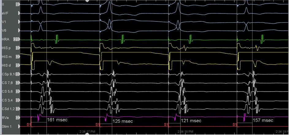 Not what we expected! Selective His pacing with VA time ~160ms, non-selective ParaHisian pacing with VA time ~120ms. Instead of equal VA time during ParaHisian pacing, a paradoxical difference in VA time revealed the presence of an AP! @docwhitman @AnujBasil @narrowQRS