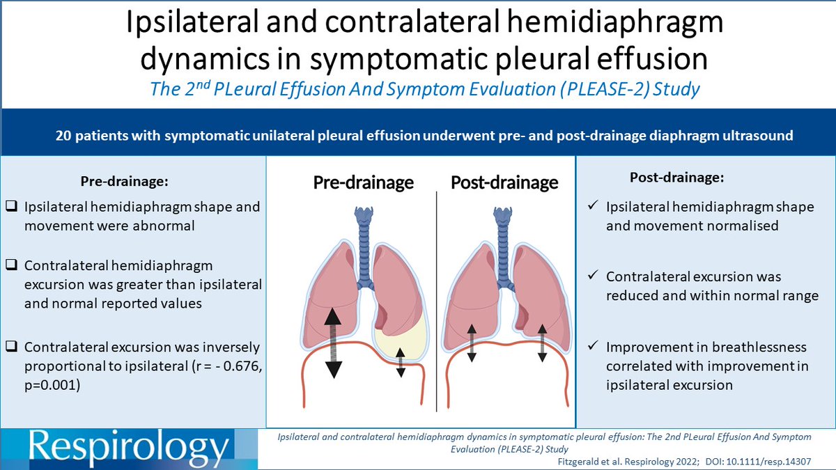Respirology (@respirologyapsr) on Twitter photo Ipsilateral and contralateral hemidiaphragm dynamics in symptomatic pleural effusion: The 2nd PLeural Effusion And Symptom Evaluation (PLEASE-2) Study published in #Respirology onlinelibrary.wiley.com/doi/10.1111/re… <a href="/db_fitzgerald/">DBFitzgerald</a> <a href="/YCGaryLee/">Y C Gary Lee</a> Ipsilateral and contralateral hemidiaphragm dynamics in symptomatic pleural effusion: The 2nd PLeural Effusion And Symptom Evaluation (PLEASE-2) Study published in #Respirology onlinelibrary.wiley.com/doi/10.1111/re… <a href="/db_fitzgerald/">DBFitzgerald</a> <a href="/YCGaryLee/">Y C Gary Lee</a>