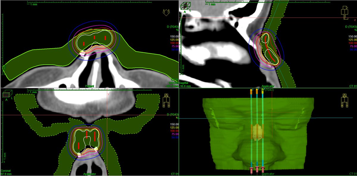 AdamChiche's tweet photo. Considering #3Dprinting surface #brachytherapy for #skincancer? Here you have a cheap #video-assisted detailed solution:
https://t.co/ecScb7uHkJ
https://t.co/ejJpuoWq3d
#ThisIsBrachytherapy #jocb #EducationalCorner https://t.co/hink0B7112