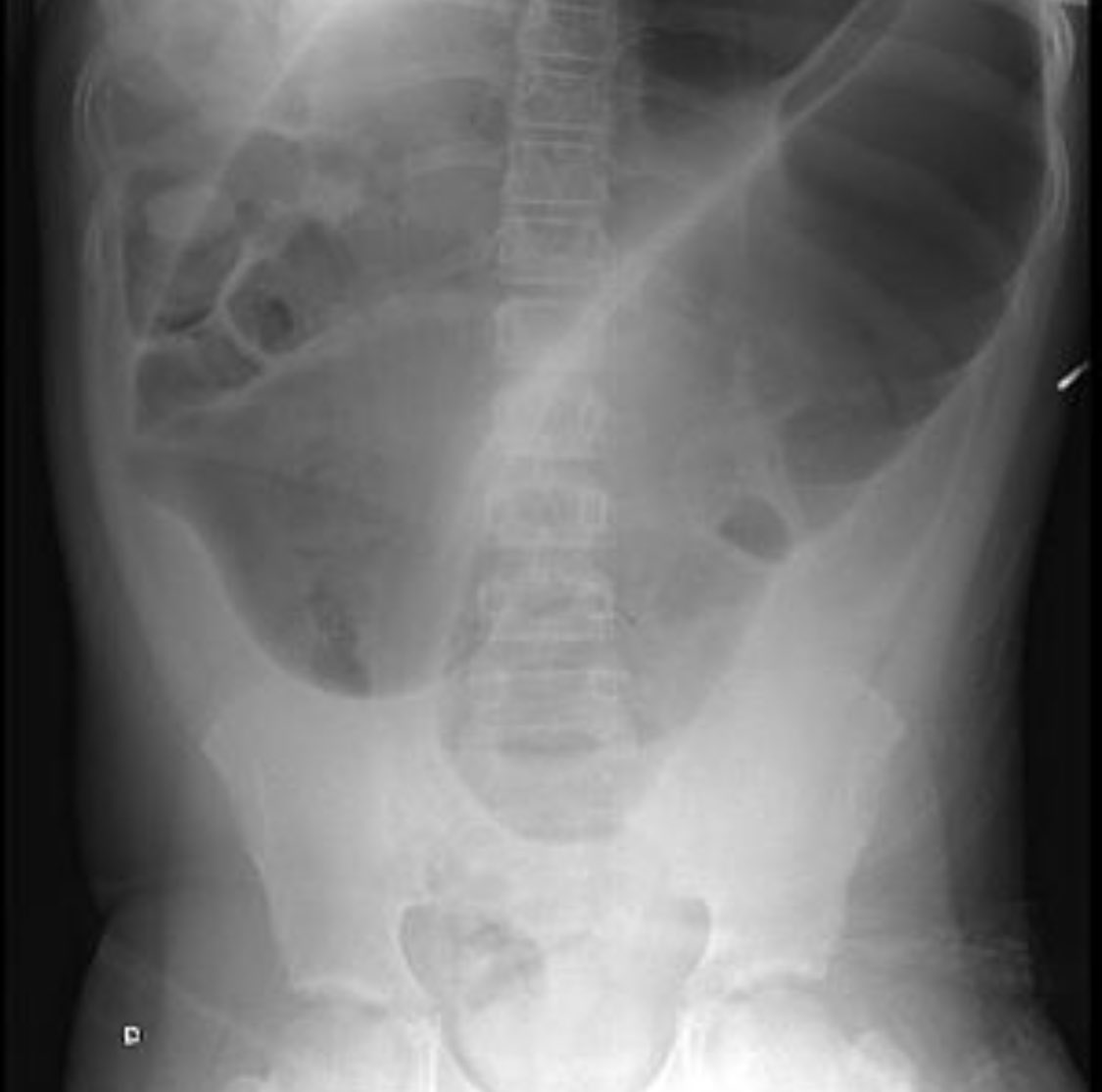 Sigmoid Volvulus Coffee Bean Sign