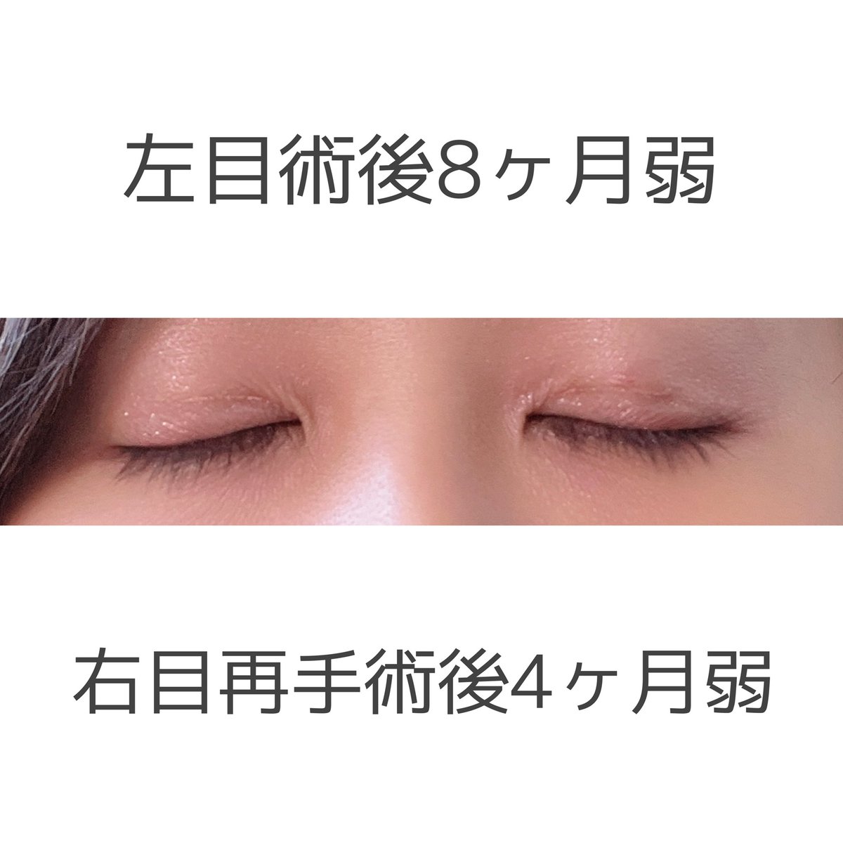 snowsmile412's tweet photo. 久々に経過です。
DT4ヶ月弱と8ヶ月弱。マスカラなし。
#眼瞼下垂 #保険適用 #二重切開 #ダウンタイム #DT https://t.co/XToIpt5lWs