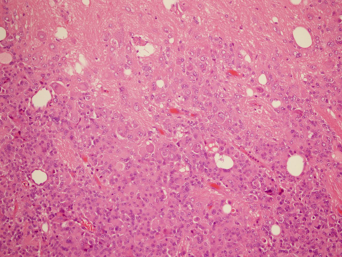MehmetKefeli's tweet image. 🔬🎭 A composite tumor from the sellar region: Mixed gangliocytoma and PitNET (formerly known as pituitary adenoma)➡️➡️➡️

#gangliocytoma #PitNET #PathTwitter #pathology #pituitary #pathologist #Endopath #endocrine
@EndoPath @Pathologists @DrSultanClskn