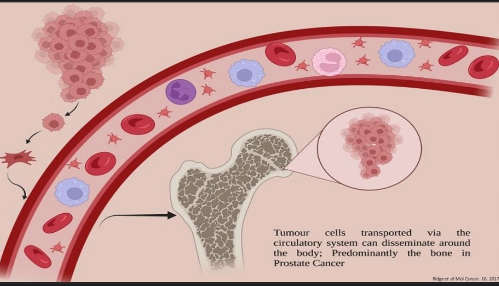 raman_suguna's tweet image. Construction of 3D spheroids

Use of synthetic hydrogel mimic tissues in TME. 

The aim of @CDTLifETIME #PhD project is to incorporate hydrogel as platforms to investigate molecular changes at cellular level for patient specific treatment in metastatic prostate cancer. #TCESxCDTs