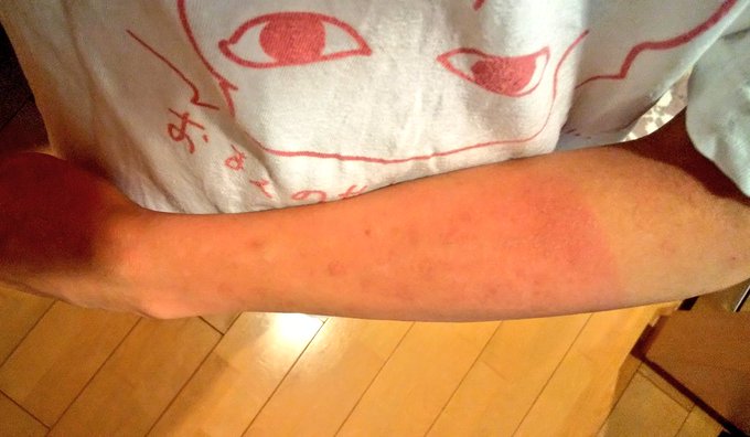 炎天下二時間くらい散歩したらめちゃ焼けた 