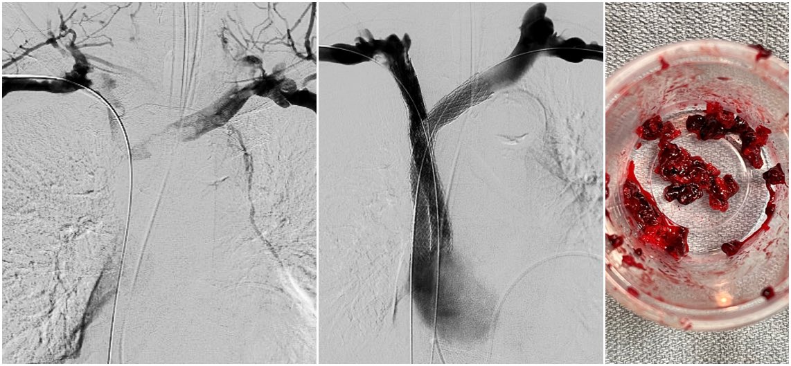 Jeffrey F. B. Chick, MD, MPH (@chickvir) on Twitter photo Malignant superior vena cava (SVC) syndrome from unknown primary. Diagnostic and therapeutic benefit from thrombectomy and stent reconstruction. #ComplexVenousDisease <a href="/InariMedical/">Inari, now part of Stryker</a> <a href="/SIRspecialists/">Society of Interventional Radiology</a> <a href="/UofWa_IR/">University of Washington IR Residency</a> <a href="/CVIR_Journal/">CVIR Journal</a> <a href="/davidsshin/">David Shin</a> <a href="/mabadsantos/">Matt Abad-Santos</a> <a href="/ajeyakumar12/">Arthie Jeyakumar</a> Malignant superior vena cava (SVC) syndrome from unknown primary. Diagnostic and therapeutic benefit from thrombectomy and stent reconstruction. #ComplexVenousDisease <a href="/InariMedical/">Inari, now part of Stryker</a> <a href="/SIRspecialists/">Society of Interventional Radiology</a> <a href="/UofWa_IR/">University of Washington IR Residency</a> <a href="/CVIR_Journal/">CVIR Journal</a> <a href="/davidsshin/">David Shin</a> <a href="/mabadsantos/">Matt Abad-Santos</a> <a href="/ajeyakumar12/">Arthie Jeyakumar</a>