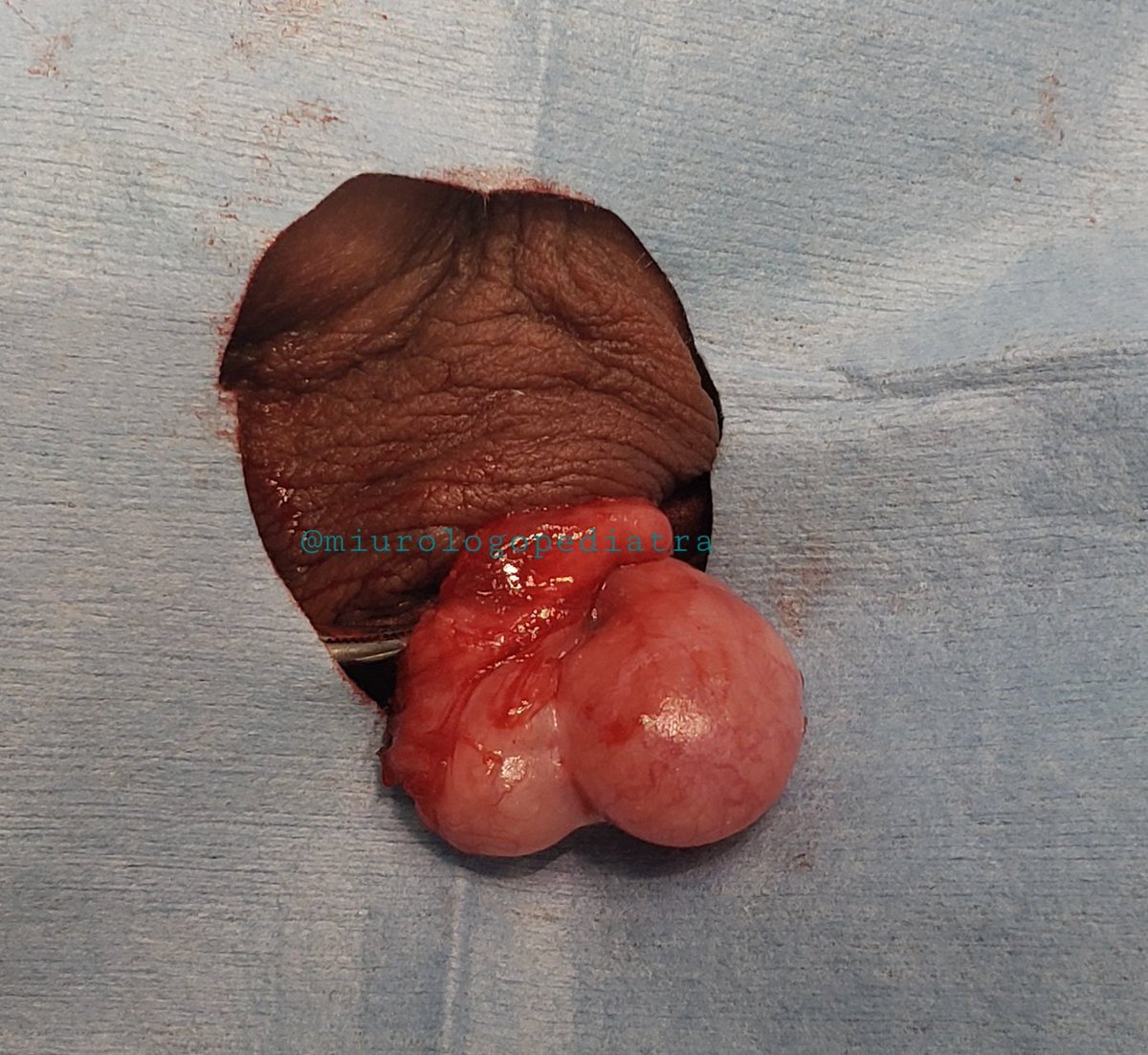 The interesting case of the week...
Have you seen a case like this?
Bilobed #testicle

#miurologopediatra #HIMFG #StarmedicaHIP
#urologiapediatrica #pediatricsurgery #PedUroSoMe
#pediatricorology #urology #SoMe4PedSur