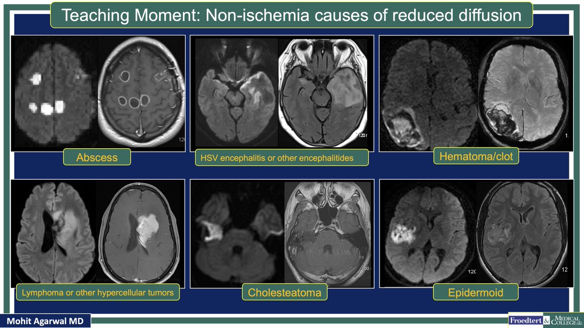 #MCWNeuroradBTW 074Ans: PCNSL

#TeachingMoment on DWI bright lesions

#FOAMed #radres #MedEd @TheASNR @ARRS_Radiology @BSHNI_UK @ESNRad @BshniTrainees @ESHNRSociety @bdoop3210 @MCWNeurorad @AwanRad @aaronrutman @RadDiscord @ASHNRSociety @AURtweet @FatimaElahi21 @drSurjthVattoth