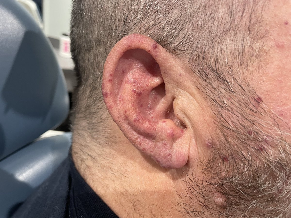 WilliamRBlythe's tweet photo. Hereditary Hemorrhagic Telangectasia. (Osler-Weber-Rendu). The scourge of the patient and Otolaryngology. The first thing I tell these patients is, “This is a marriage, not a date.”
#GeneralENT https://t.co/WWeku78DhJ