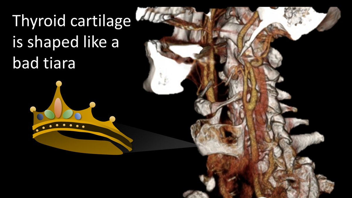 9/Thyroid cartilage is shaped like a bad tiara--except it has points going both up & down. It looks like one of those tiaras you thought would look great w/your prom dress at 16 &now you are stuck w/horrible photos where you look like a bad Disney princess--or was that just me?