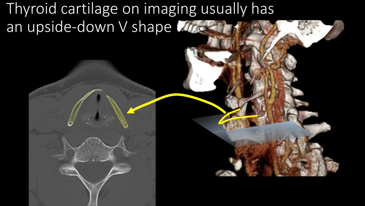 10/Because it is open posteriorly, like a tiara, and slightly pointed, on imaging--in cross section--it looks like a upside down letter V