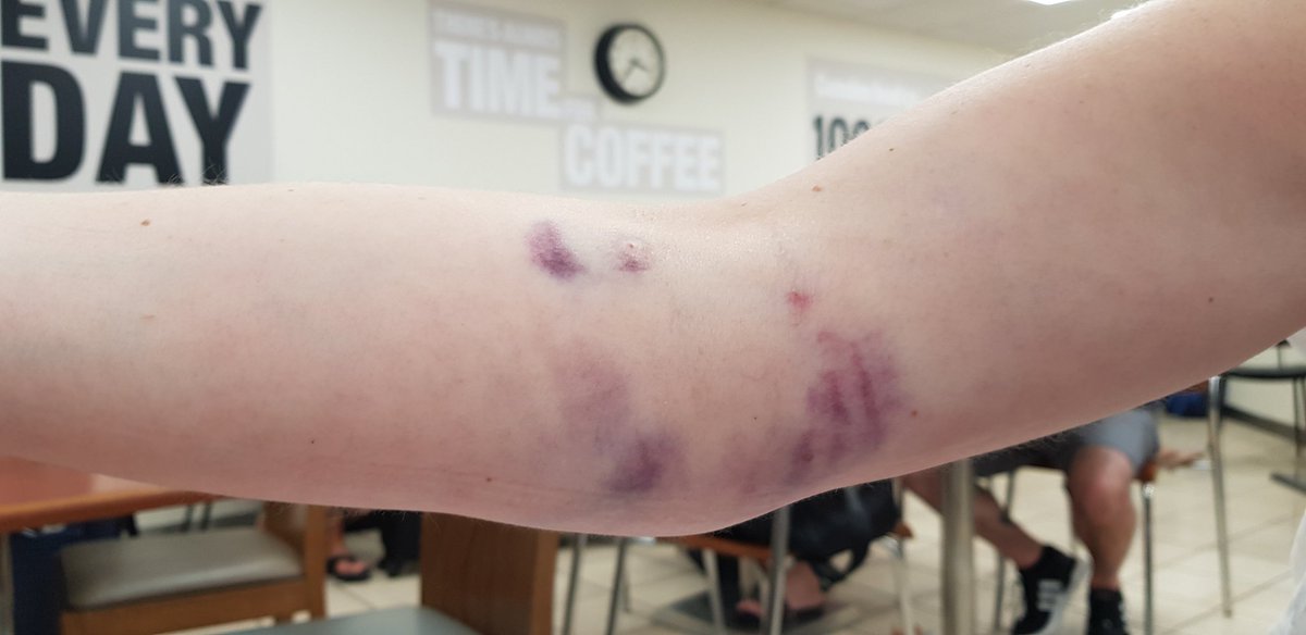 nouveaucakes's tweet photo. @GiveBloodNHS hi I give blood every 3 months and never have had a problem. However after yesterday's blood donation I'm not sure whether I want to continue. Really painful and bruised arm! Not sure how to feedback hence the tweet. https://t.co/bySM6gHj2q