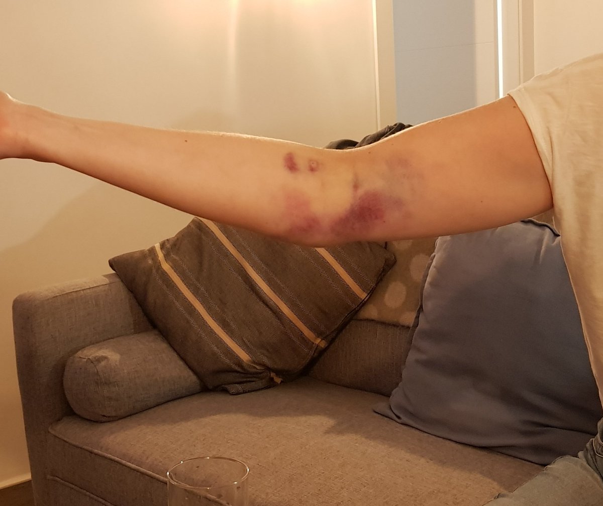 nouveaucakes's tweet photo. @GiveBloodNHS hi I give blood every 3 months and never have had a problem. However after yesterday's blood donation I'm not sure whether I want to continue. Really painful and bruised arm! Not sure how to feedback hence the tweet. https://t.co/bySM6gHj2q