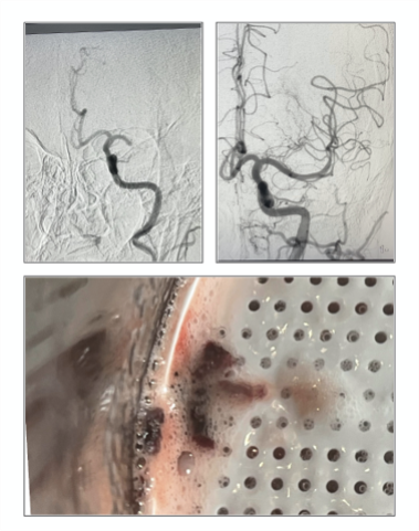 PenNeuro's tweet image. US HCPs: #RED62 delivers results in the hands of Dr. Thomas Windisch out of Covenant Medical Center in Lubbock, TX. #REDglideDifference Rx only. For risk info: bit.ly/37YcYIU Clinical results may vary.