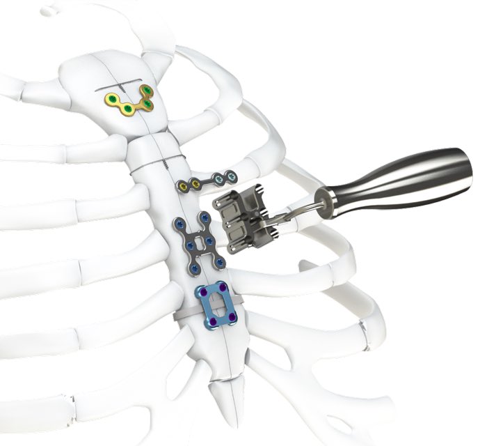 CoreyBushmaker's tweet photo. The SternaLock family just got better!
Welcome SternaLock EZ!
#sternalock #sternalockez #closeitright #zimmerbiomet @zimmerbiomet https://t.co/bgASr6tFUs
