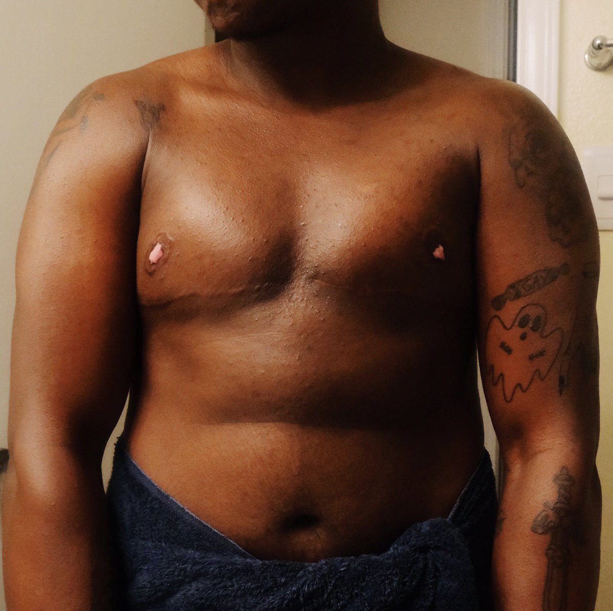 6 months post-op ❤️‍🔥 not enough Black trans #topsurgery results on the innanet so here you go 🥰