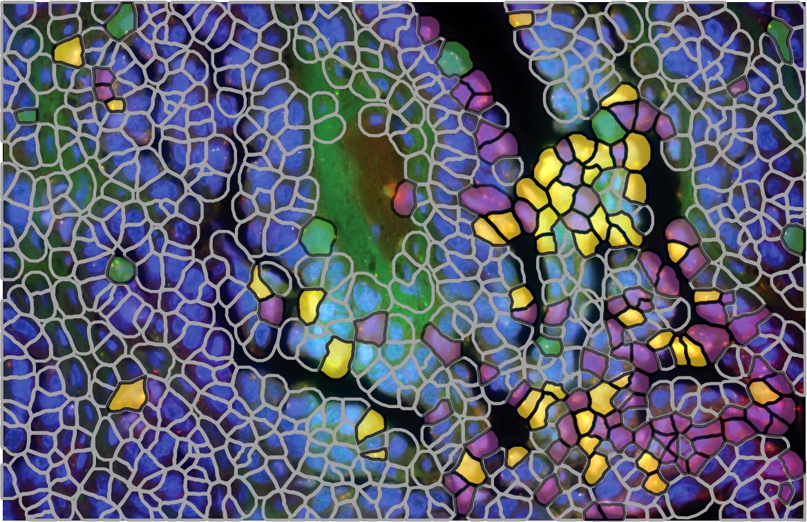 Stained glass window on cancer. Drug resistant cells (gold) are identified using allele specific amFISH pnas.org/doi/10.1073/pn…