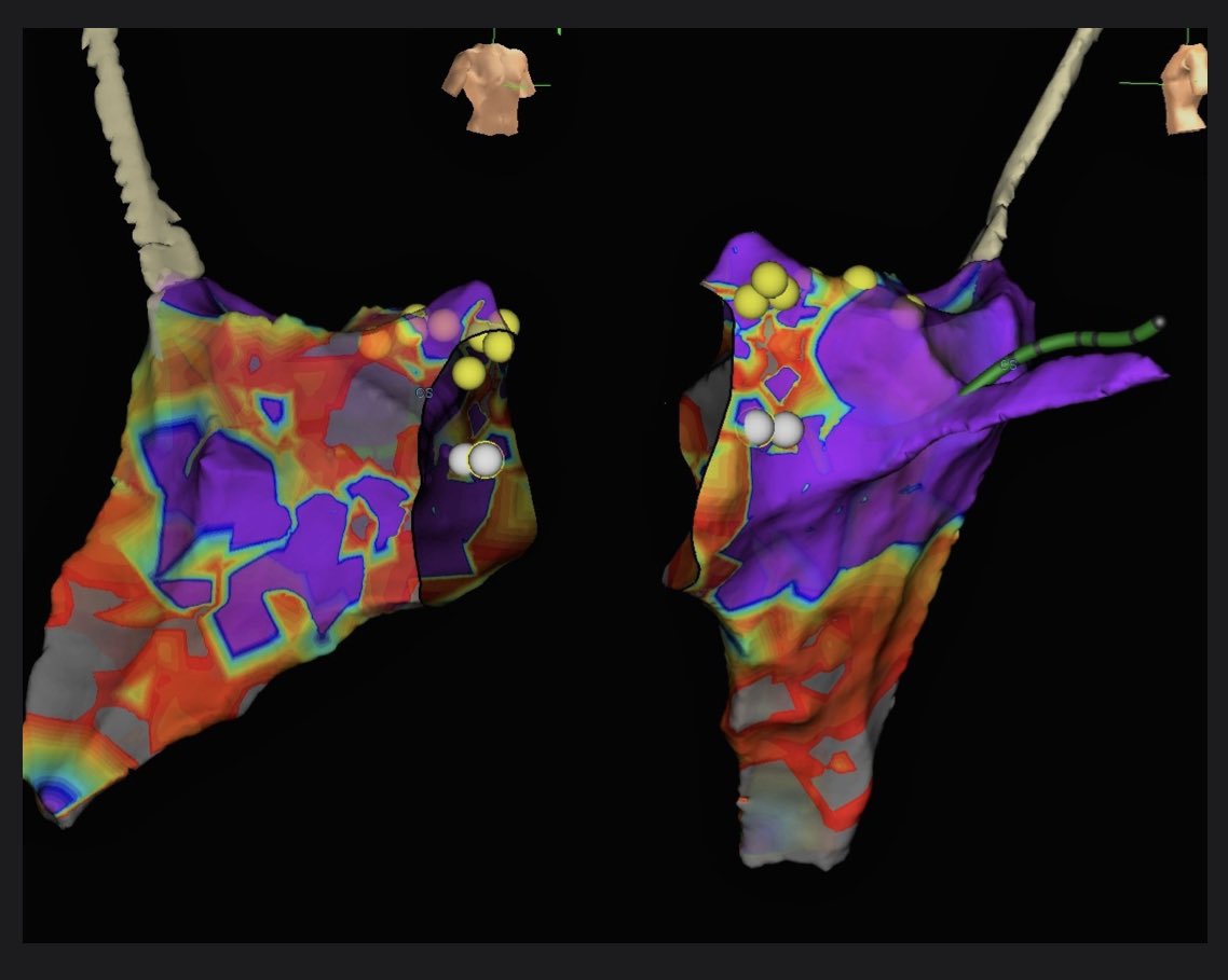 AZ_EP_DOC's tweet photo. I’ve been fluoro-less pretty much since fellowship.. but this was my first completely “un-leaded” ESI case. Thanks @HeidiStover2 and @alexnhirsch !! @XavierR_EP missed all the fun. #noflouro #looseyourlead#progress https://t.co/pTSHYNklOa