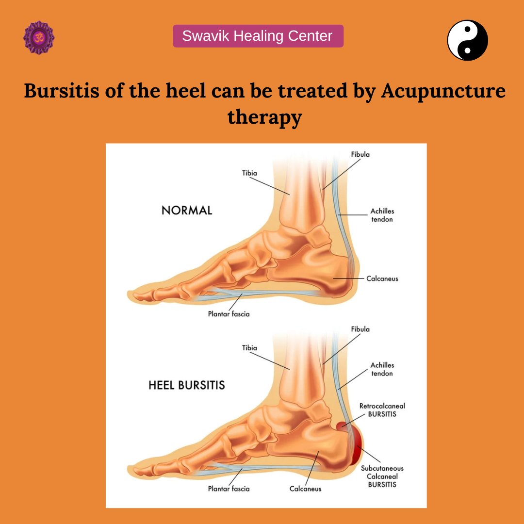 ➡️ Acupuncture point PC7 is an important point for ''Heel Pain